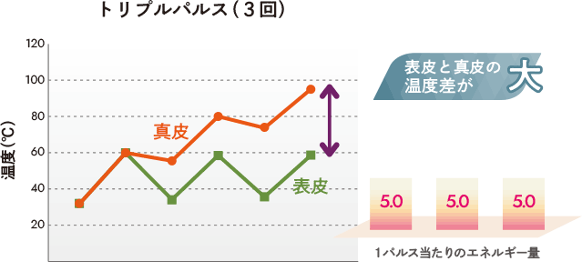 トリプルパルス（3回）表皮と真皮の温度差が大