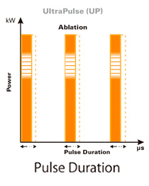 炭酸ガスレーザー SmartXide Touch（スマートサイド・タッチ）Ultimate-Pulse (UP)ウルティメイトパルスモード